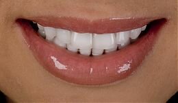 Восстановление цвета и формы зубов