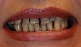 Протезирование на 16-ти имплантатах после удаления всех зубов