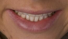 Восстановление цвета и формы зубов